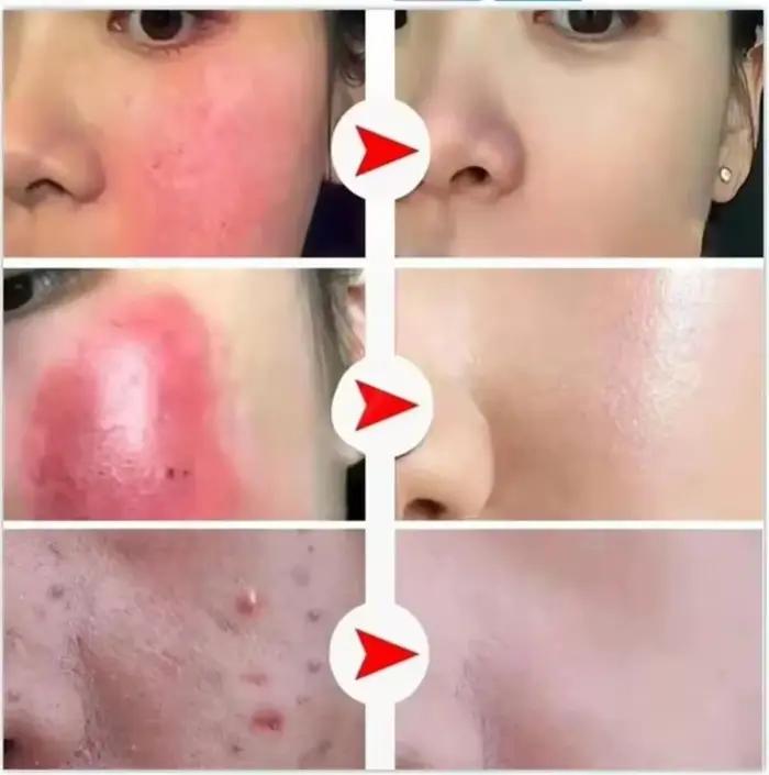 Crème Réductrice de Rougeurs Faciales
