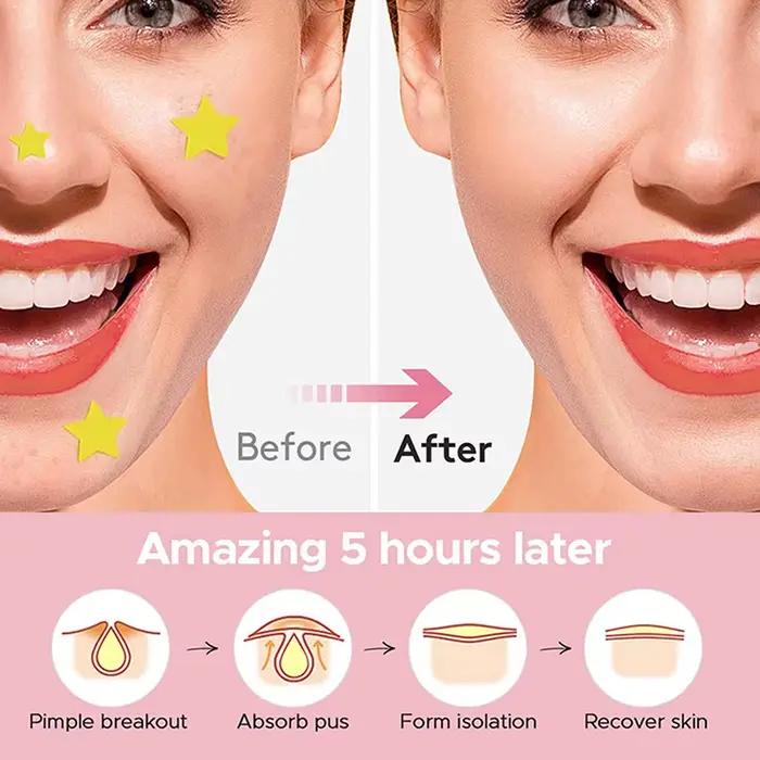 Star Pimple Patch pour l'acné