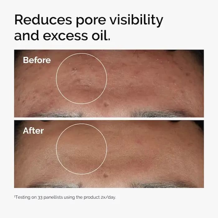 Niacinamide 10% + Zinc 1% sérum 30ml améliore la luminosité de la peau améliorer la Texture réduire l'excès d'huile