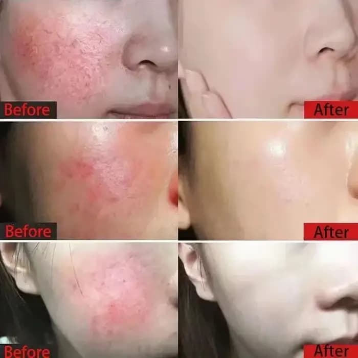 Crème Réparatrice Anti-Rougeurs Visage – Améliore la Peau Sensible et la Sécheresse – Hydratant Apaisant – Élimine la Rosacée – Cosmétiques Coréens