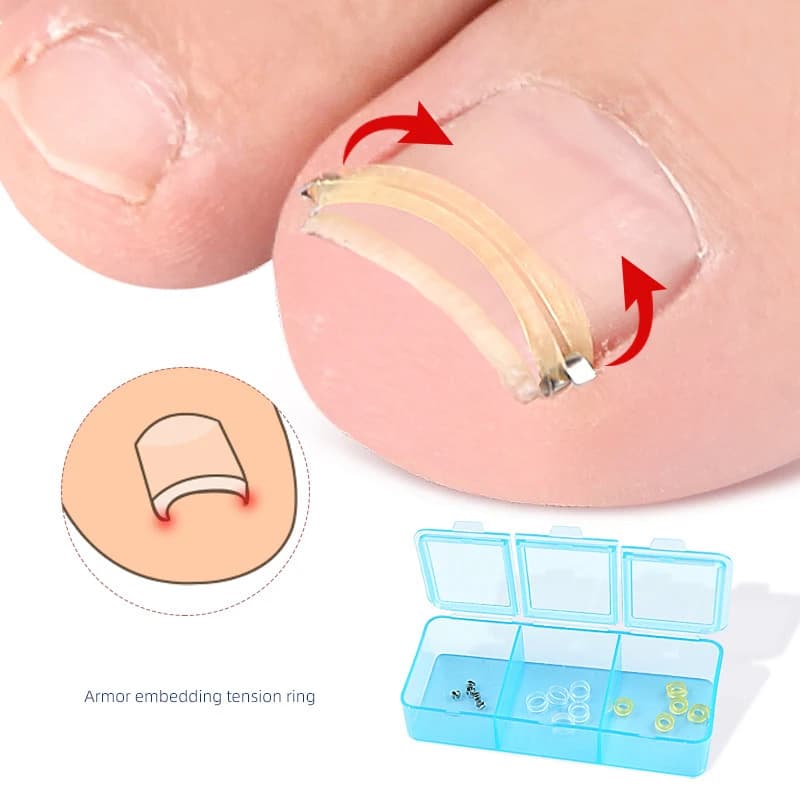 Correcteur d'ongles incarnés, pédicure, récupération intégrée, traitement des ongles des orteils, Pa