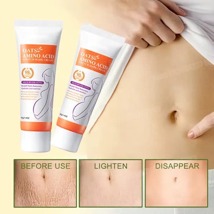 Crème anti-vergetures, lignes lumineuses