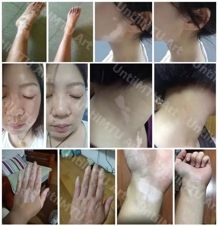 Couverture de Camouflage pour peau de Vitiligo