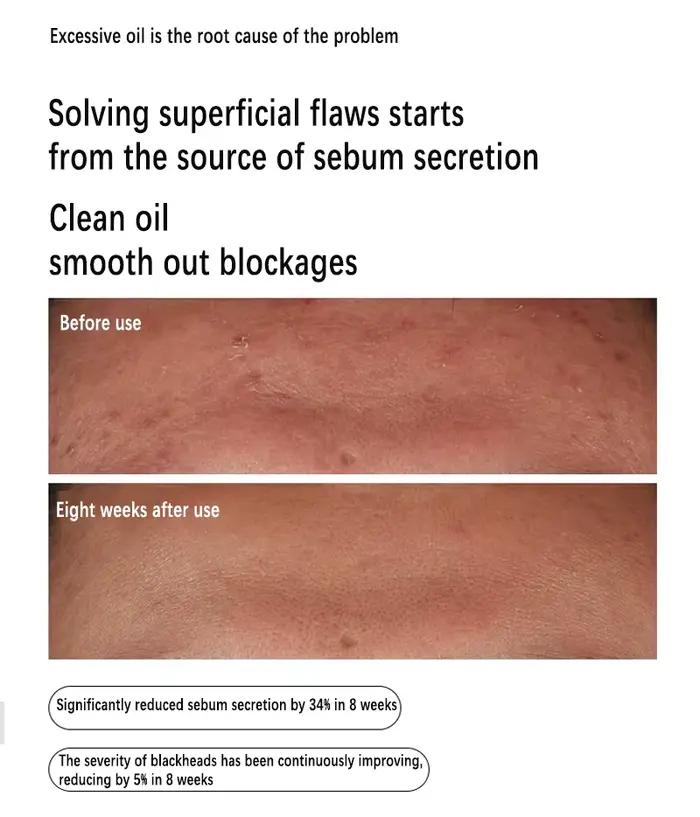 Sérum niacinamide 10% zinc 1% face control sébum acné peau grasse pores resserrés éclatant visage beauté santé skincare face serum the ordinary